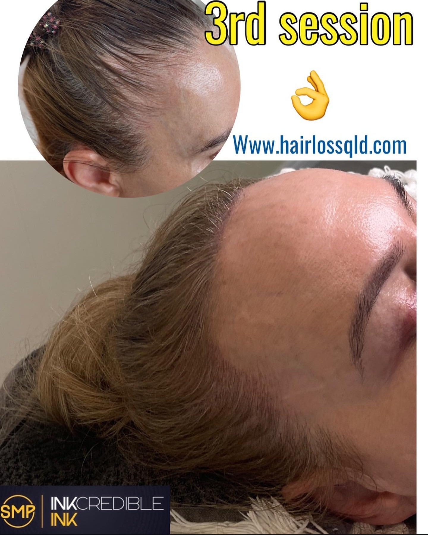 Hairline Restoration Brisbane